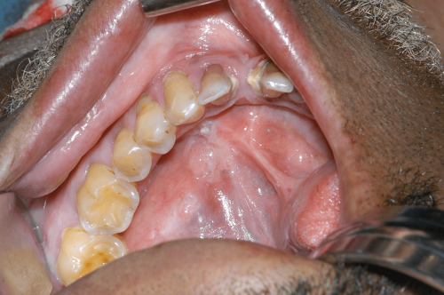 Floor of Mouth Cancer - Mucoepidermoid carcinoma