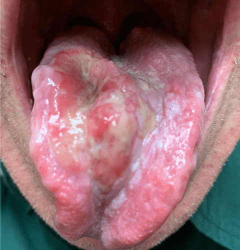 Tongue Cancer - Near total squamous cell carcinoma