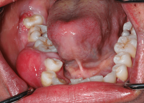 Jaw Benign Tumor -  Odntogenic Myxoma