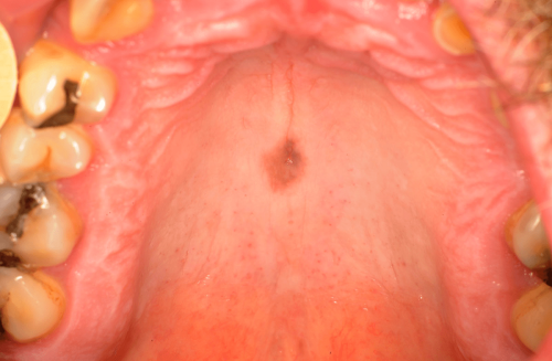 Palatal melanosis -  Benign change