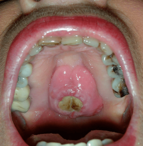 Palatal torus with ulceration -  Benign change