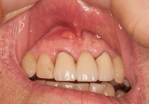 Gum Benign Change - Periapical abscess