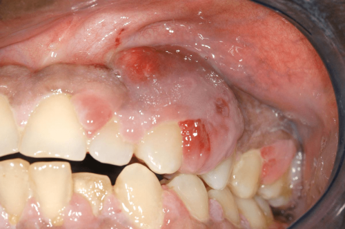 Peripheral giant cell tumor - Benign tumor