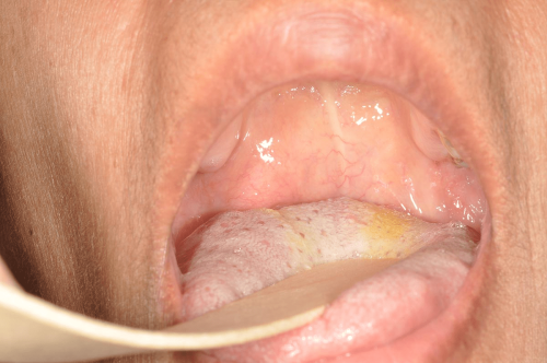 Back of the throat benign tumor - Pleomorphic adenoma