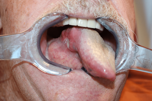 Tongue Cancer - Posterior squamous cell carcinoma