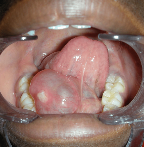 Floor of Mouth Benign Change - Ranula