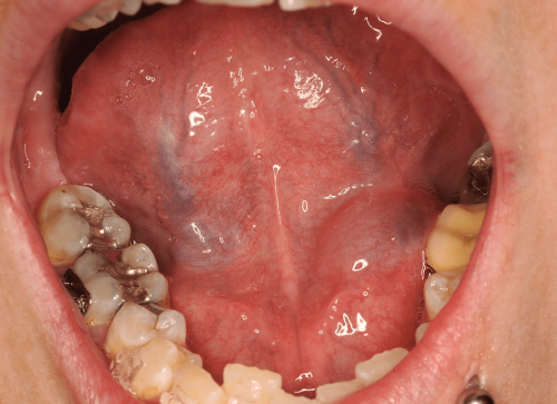 Floor of Mouth Benign Change - Ranula