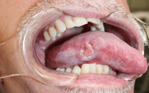 Tongue Cancer - Squamous cell carcinoma