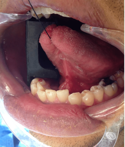 Floor of Mouth Cancer - Squamous cell carcinoma