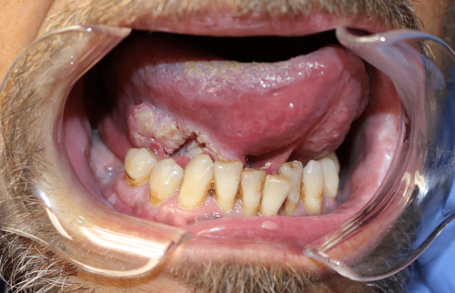 Tongue Cancer - Squamous cell carcinoma