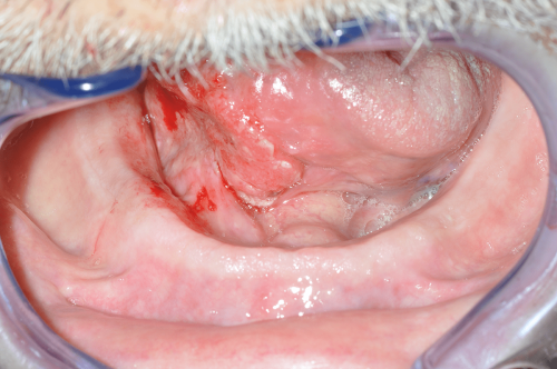 Floor of Mouth Cancer - Squamous cell carcinoma