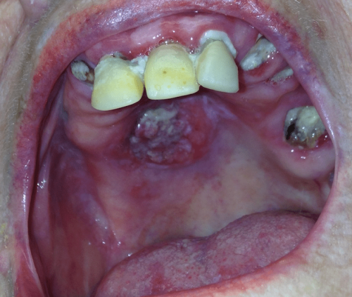 Squamous cell carcinoma - Cancer