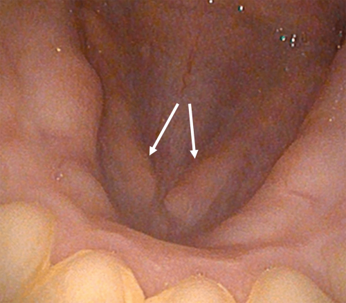 Floor of Mouth Normal Anatomy - Submandibular Ducts