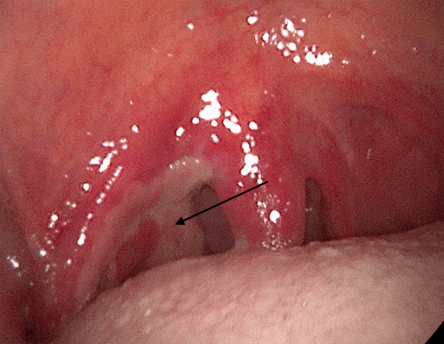 Back of the throat cancer - Tonsil squamous cell carcinoma 2