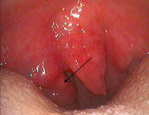 Back of the throat cancer - Tonsil squamous cell carcinoma 3