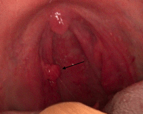 Back of the throat cancer - Tonsil squamous cell carcinoma 4