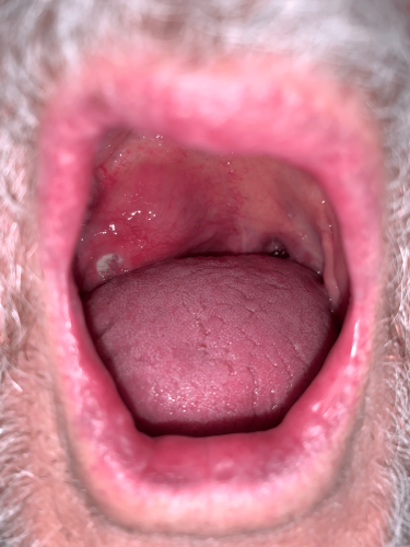 Back of the throat cancer - Tonsil squamous cell carcinoma