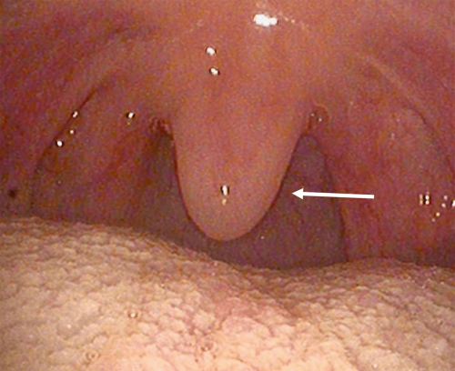 Back of the throat normal anatomy - Uvula