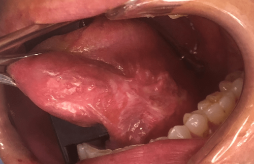 Tongue Cancer -Ventral squamous cell carcinoma