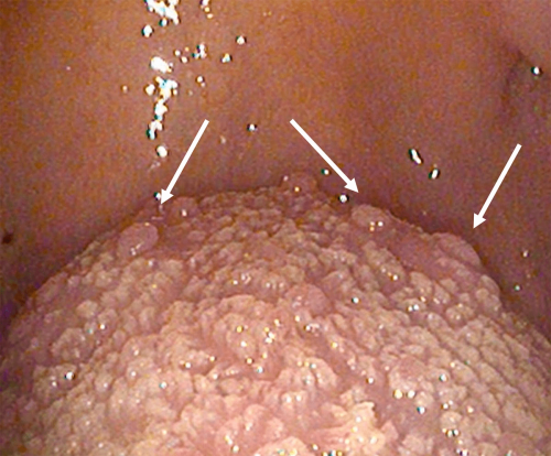 Normal Tongue Anatomy - Base of tongue and circumvallate papillae