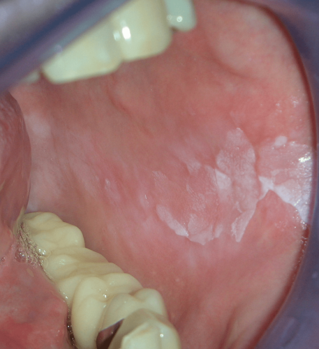 Cheek Pre-cancer - Buccal mucosa leukoplakia