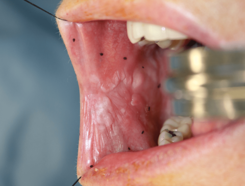 Cheek cancer - Buccal squamous cell carcinoma