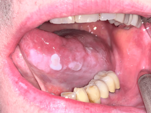 Floor of Mouth Precancer - Ventral tongue leukoplakia