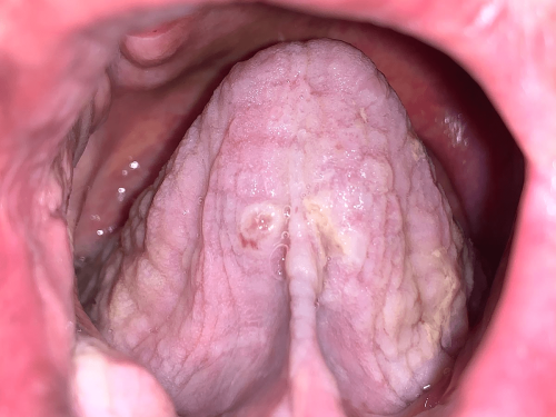 Floor of Mouth Precancer - Ventral tongue leukoplakia